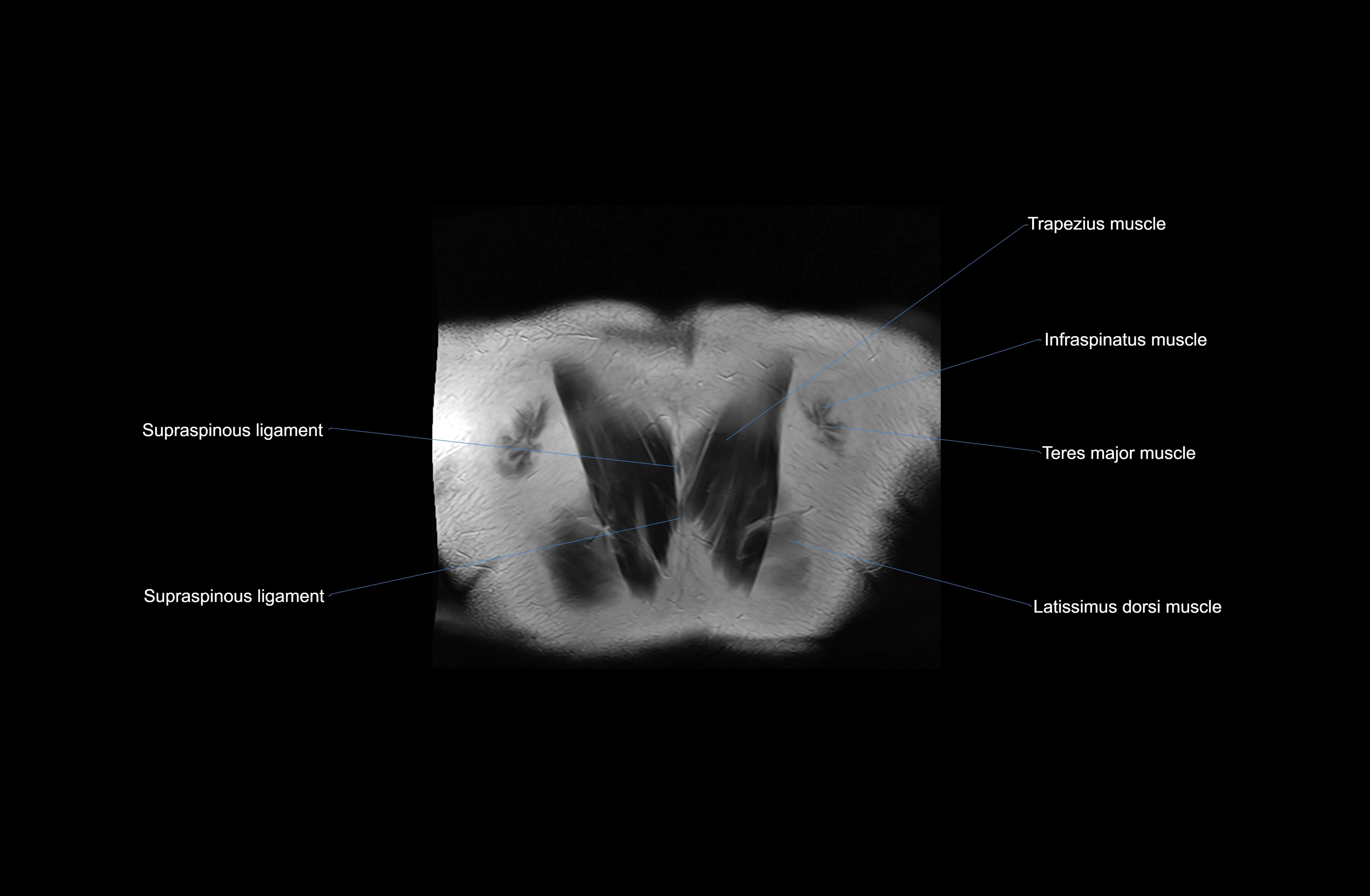 MRI chest (thorax) coronal  cross sectional anatomy 3T radiology  image-img-00001-00044.webp